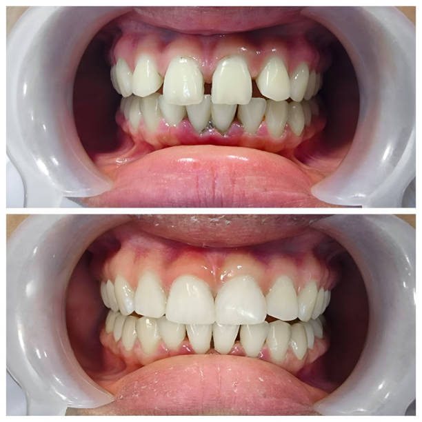 Best Full Mouth Reconstruction  in El Portal, FL